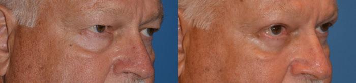 Eyelid Surgery Before & After Gallery - Patient 521519 - Image 2