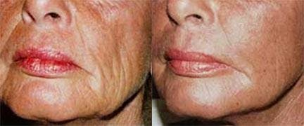 Dermal Fillers Before & After Gallery - Patient 122405740 - Image 1