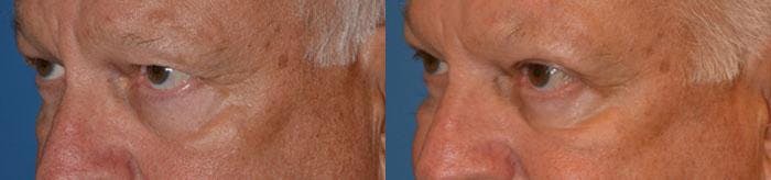 Eyelid Surgery Before & After Gallery - Patient 122405741 - Image 3