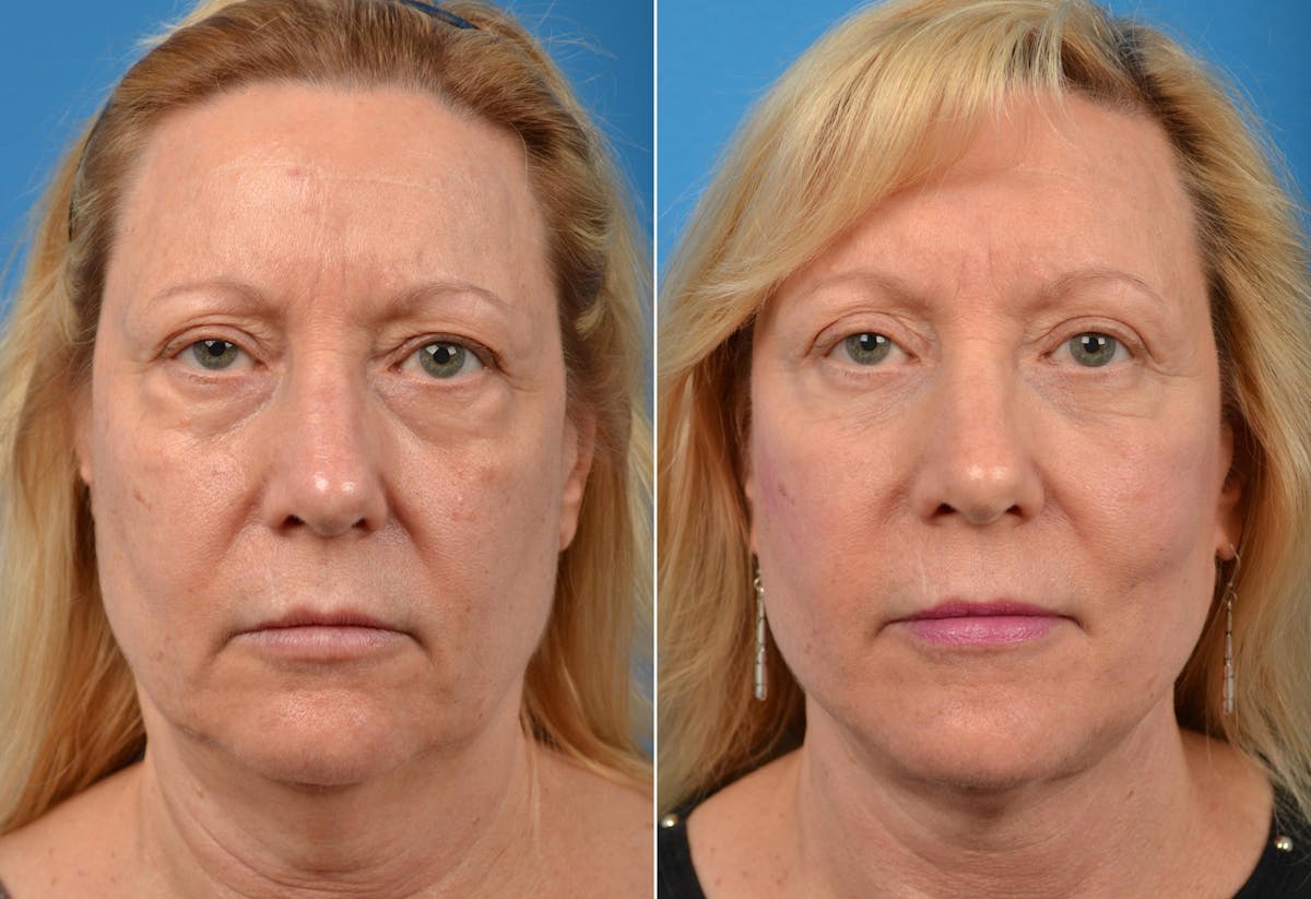 Facelift Before & After Gallery - Patient 122405751 - Image 1