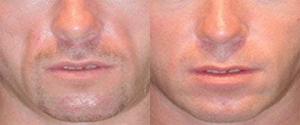 Dermal Fillers Before & After Gallery - Patient 122405742 - Image 1
