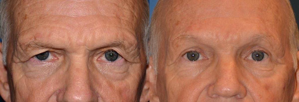 Eyelid Surgery Before & After Gallery - Patient 122405744 - Image 1