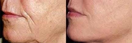 Dermal Fillers Before & After Gallery - Patient 122405743 - Image 1