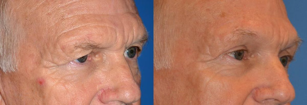 Eyelid Surgery Before & After Gallery - Patient 122405744 - Image 2