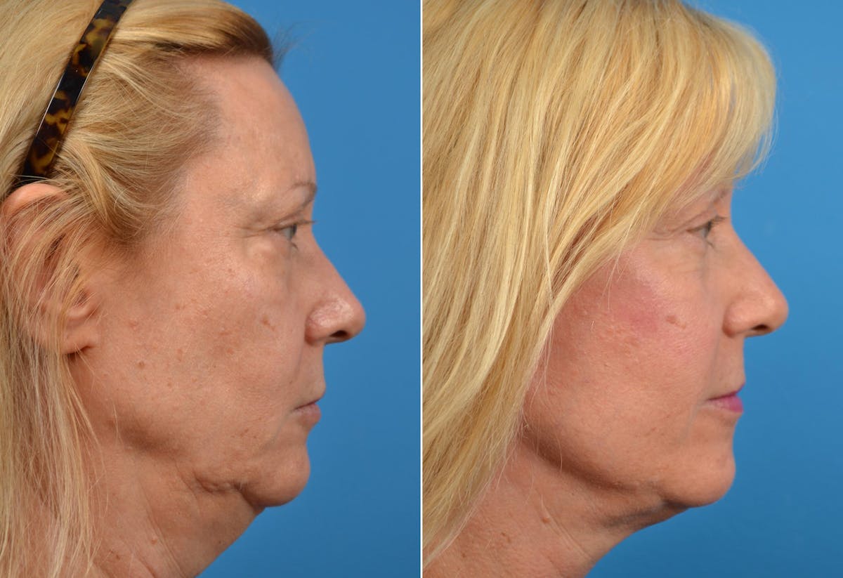 Facelift Before & After Gallery - Patient 122405751 - Image 2