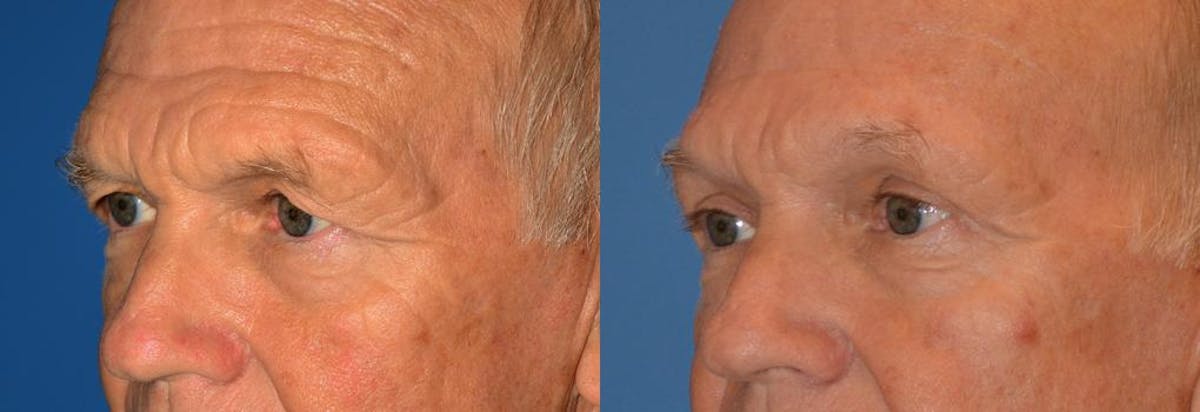 Eyelid Surgery Before & After Gallery - Patient 122405744 - Image 3
