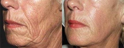 Dermal Fillers Before & After Gallery - Patient 122405745 - Image 1