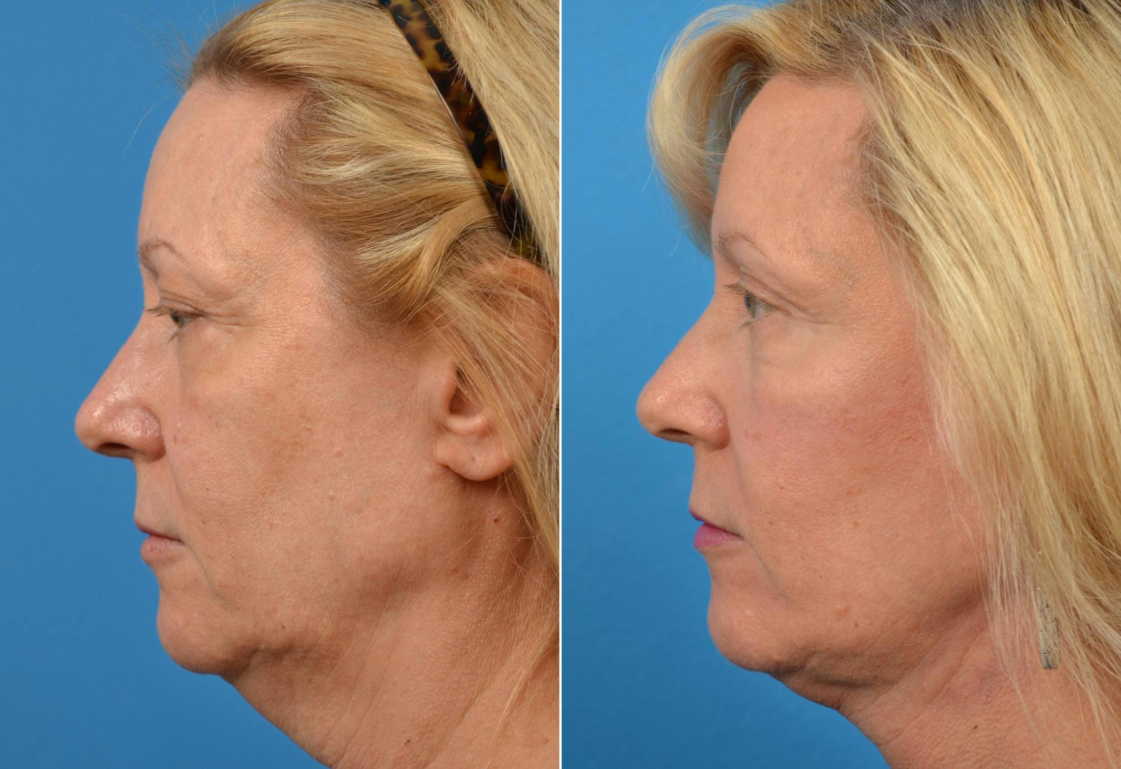 Facelift Before & After Gallery - Patient 122405751 - Image 3
