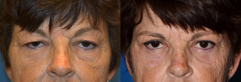 Eyelid Surgery Before & After Gallery - Patient 122507 - Image 1