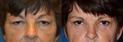 Eyelid Surgery Before & After Gallery - Patient 122405749 - Image 1