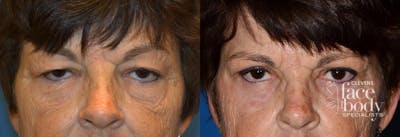 Eyelid Surgery Before & After Gallery - Patient 122507 - Image 1