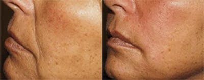 Dermal Fillers Before & After Gallery - Patient 122405747 - Image 1