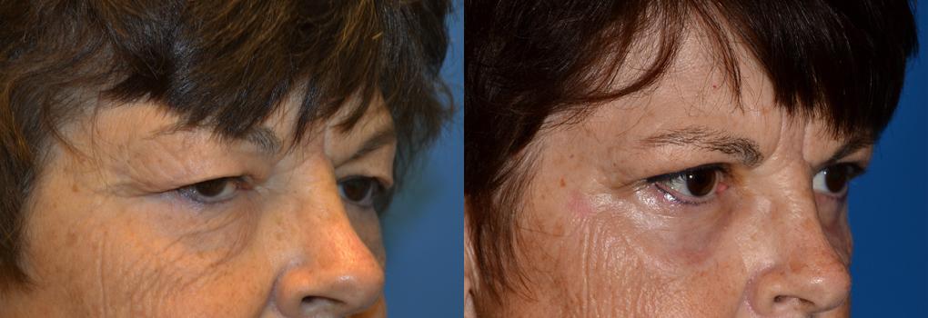 Eyelid Surgery Before & After Gallery - Patient 122507 - Image 2