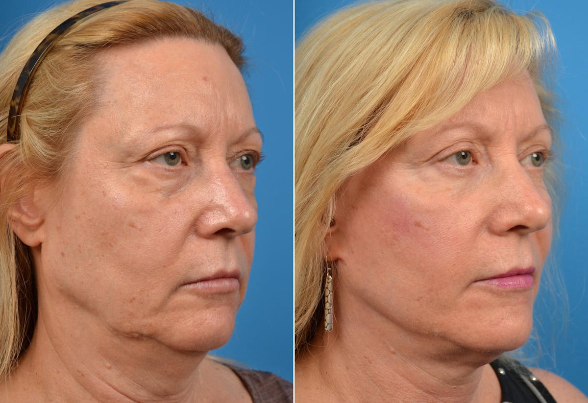 Facelift Before & After Gallery - Patient 122405751 - Image 4