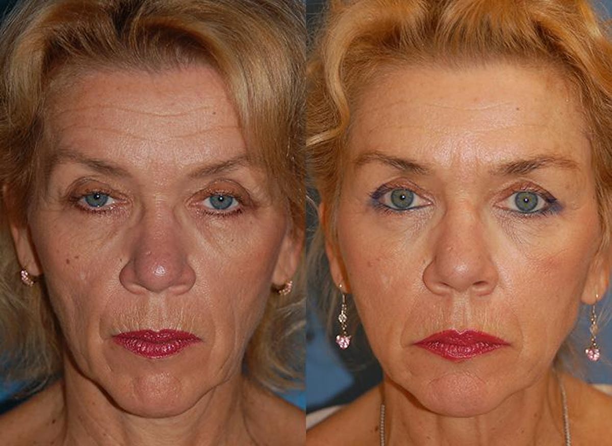 Dermal Fillers Before & After Gallery - Patient 122405748 - Image 1