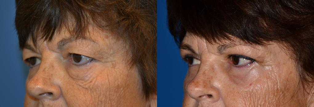 Eyelid Surgery Before & After Gallery - Patient 122507 - Image 3