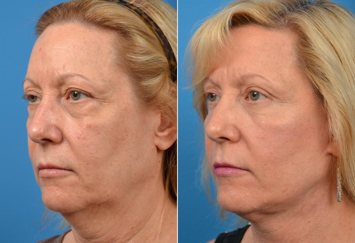 Facelift Before & After Gallery - Patient 122405751 - Image 5