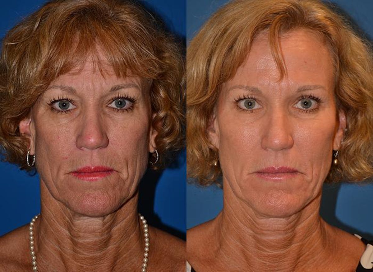 Dermal Fillers Before & After Gallery - Patient 122405750 - Image 1
