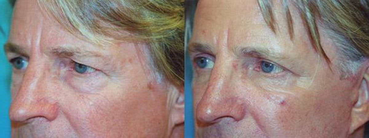 Eyelid Surgery Before & After Gallery - Patient 122405752 - Image 1