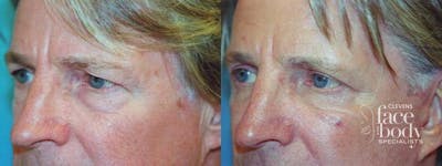 Eyelid Surgery Before & After Gallery - Patient 133527 - Image 1