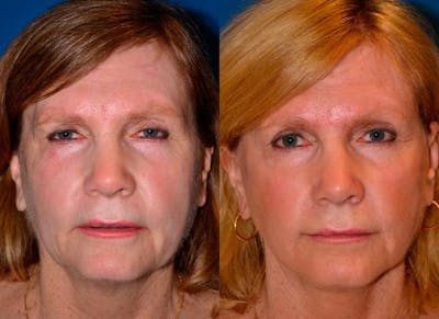 Facelift Before & After Gallery - Patient 122405755 - Image 1
