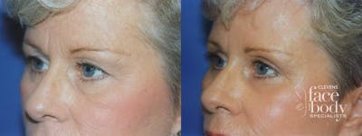 Eyelid Surgery Before & After Gallery - Patient 370362 - Image 1
