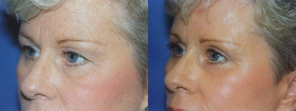 Eyelid Surgery Before & After Gallery - Patient 122405753 - Image 1