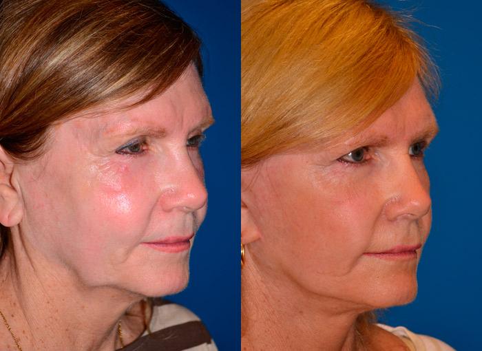 Facelift Before & After Gallery - Patient 122405755 - Image 2