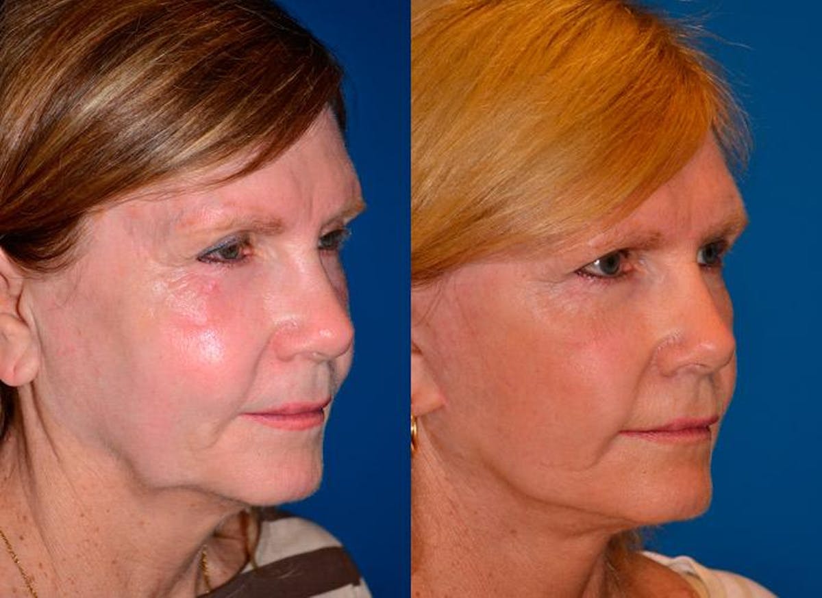 Facelift Before & After Gallery - Patient 122405755 - Image 2