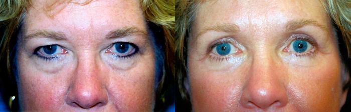 Eyelid Surgery Before & After Gallery - Patient 144846 - Image 1