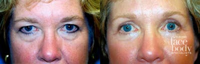 Eyelid Surgery Before & After Gallery - Patient 144846 - Image 1