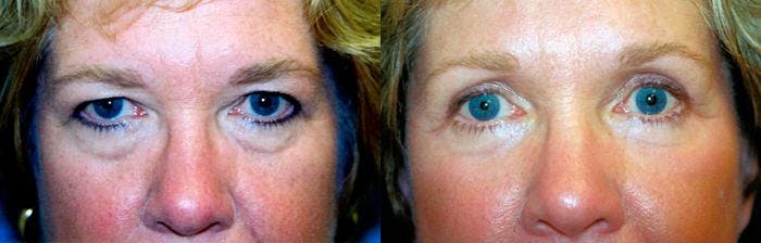Eyelid Surgery Before & After Gallery - Patient 122405754 - Image 1