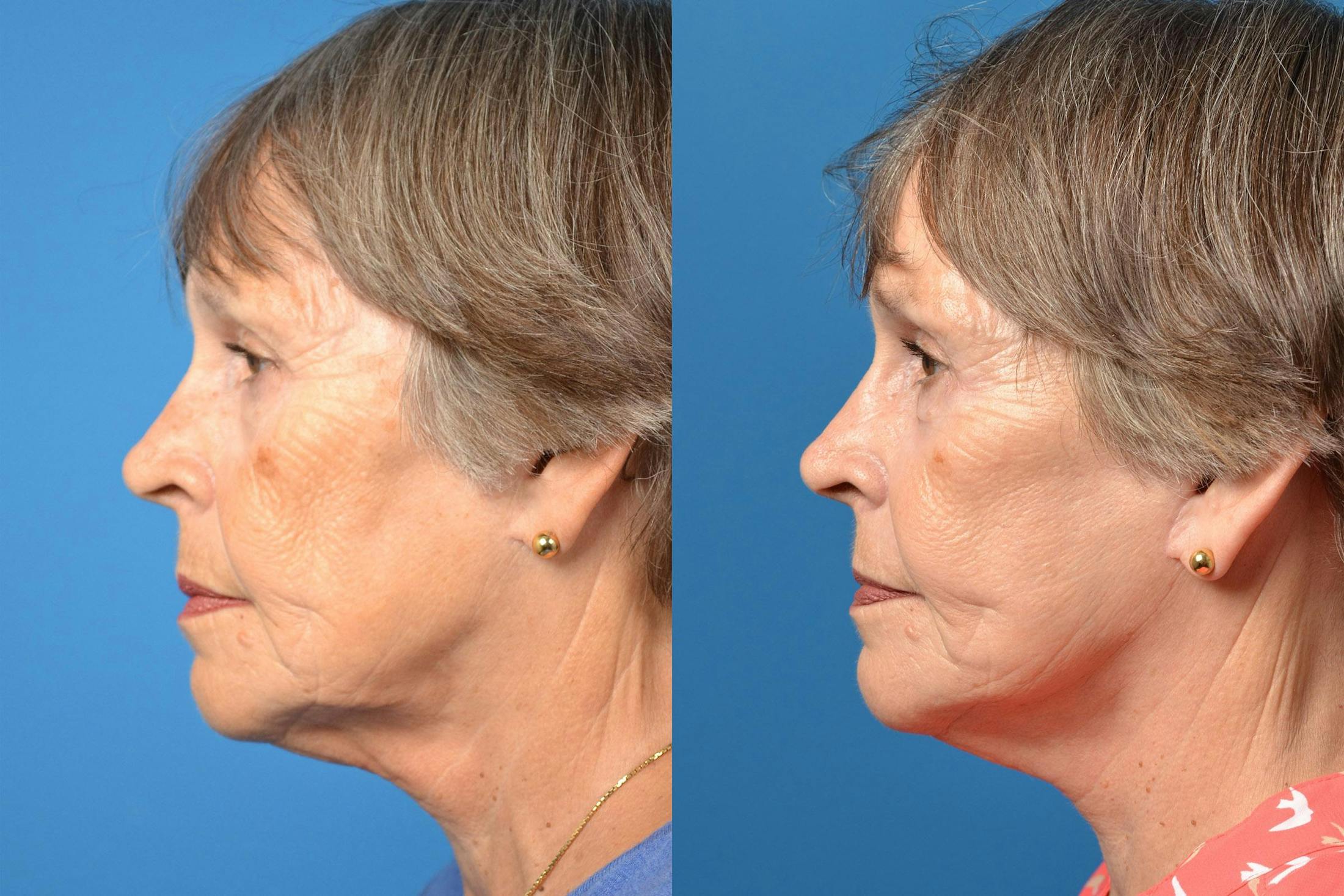 Dermal Fillers Before & After Gallery - Patient 122405757 - Image 2