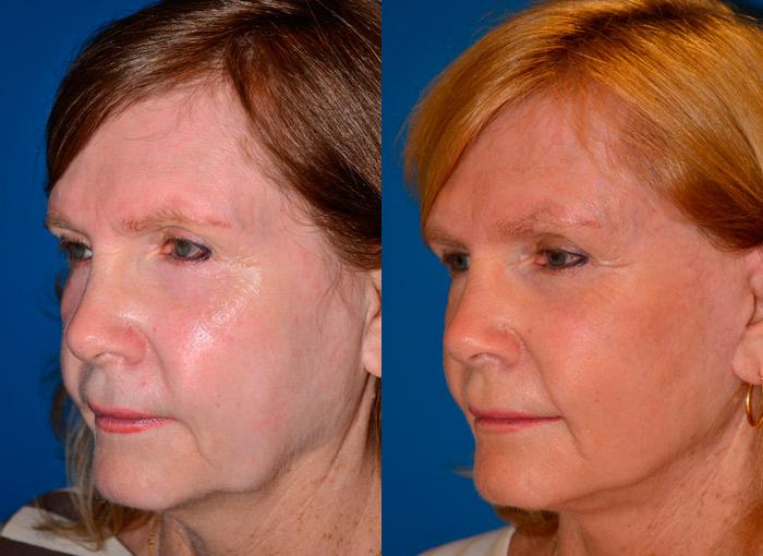 Facelift Before & After Gallery - Patient 122405755 - Image 3
