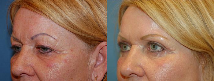 Eyelid Surgery Before & After Gallery - Patient 326811 - Image 1