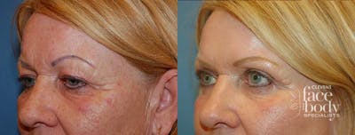 Eyelid Surgery Before & After Gallery - Patient 326811 - Image 1
