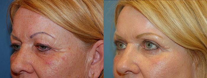 Eyelid Surgery Before & After Gallery - Patient 122405756 - Image 1