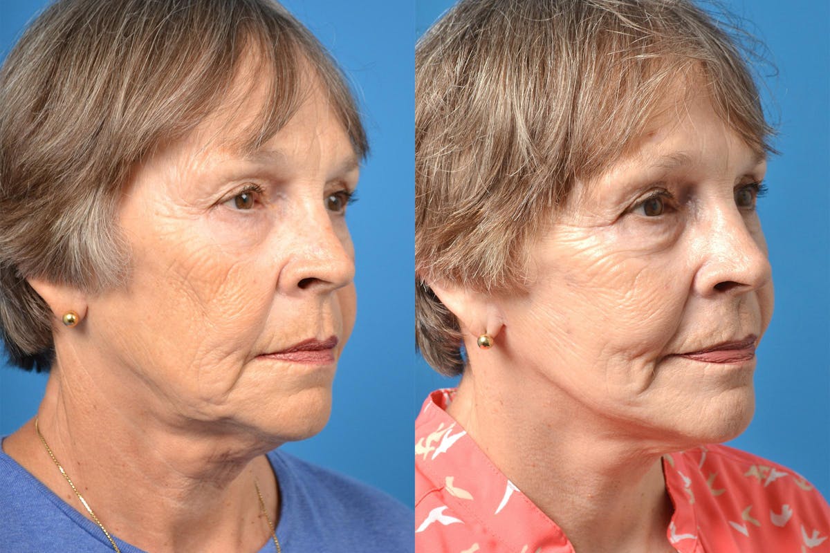 Dermal Fillers Before & After Gallery - Patient 122405757 - Image 3