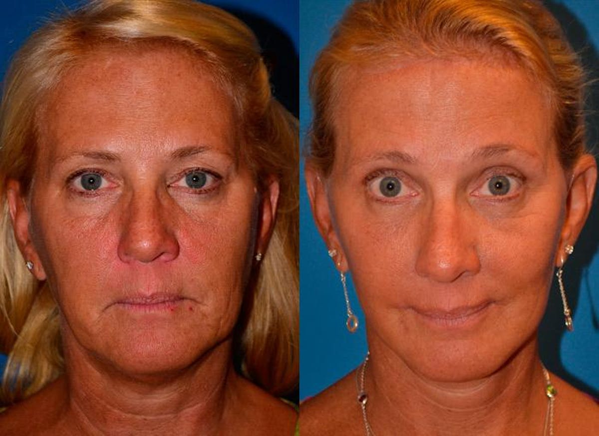 Facelift Before & After Gallery - Patient 122405759 - Image 1