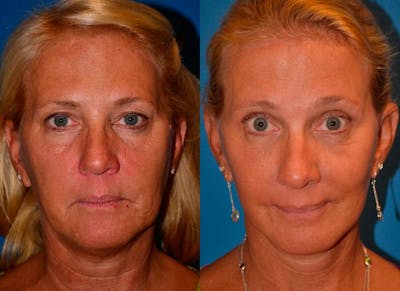 Facelift Before & After Gallery - Patient 122405759 - Image 1