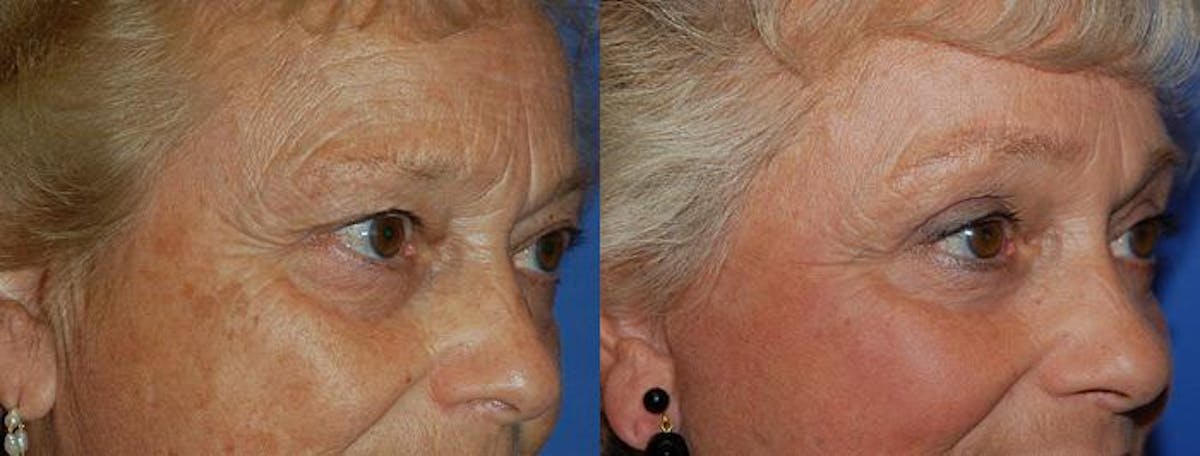 Eyelid Surgery Before & After Gallery - Patient 122405758 - Image 1