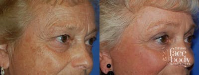 Eyelid Surgery Before & After Gallery - Patient 384499 - Image 1