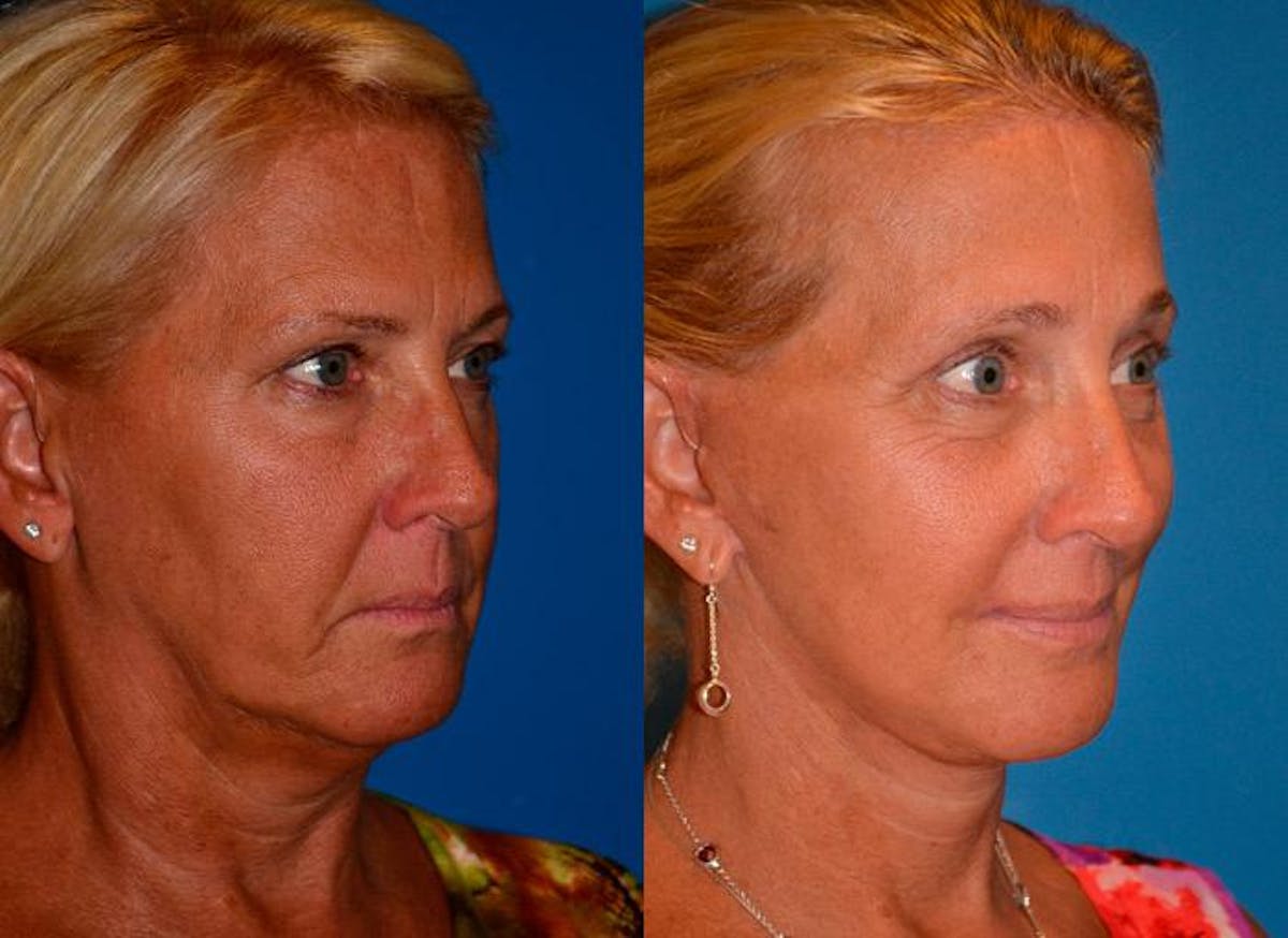 Facelift Before & After Gallery - Patient 122405759 - Image 2