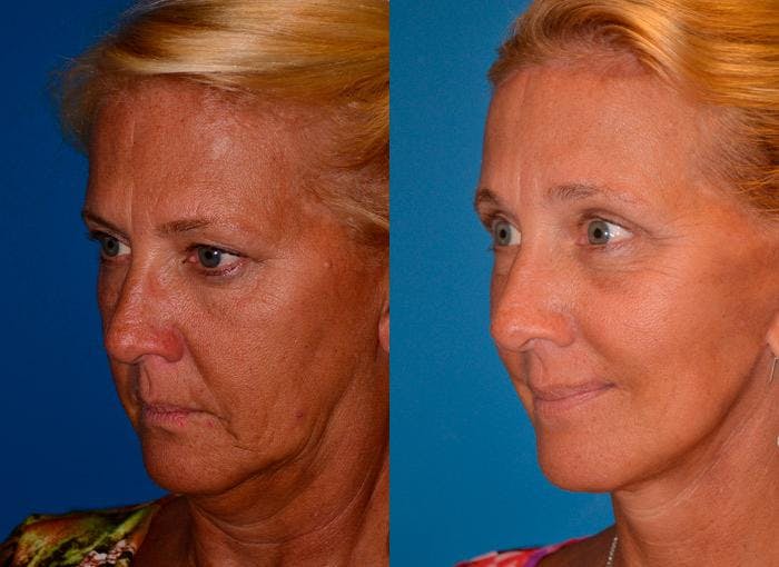 Facelift Before & After Gallery - Patient 122405759 - Image 3