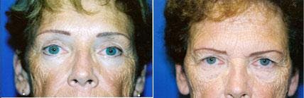 Eyelid Surgery Before & After Gallery - Patient 122405760 - Image 1