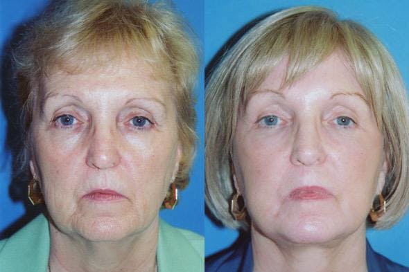 Facelift Before & After Gallery - Patient 122405763 - Image 1