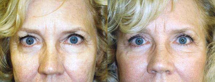 Eyelid Surgery Before & After Gallery - Patient 165389 - Image 1