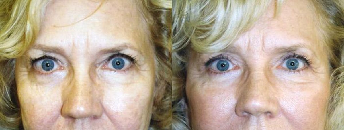 Eyelid Surgery Before & After Gallery - Patient 122405762 - Image 1