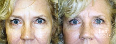 Eyelid Surgery Before & After Gallery - Patient 165389 - Image 1