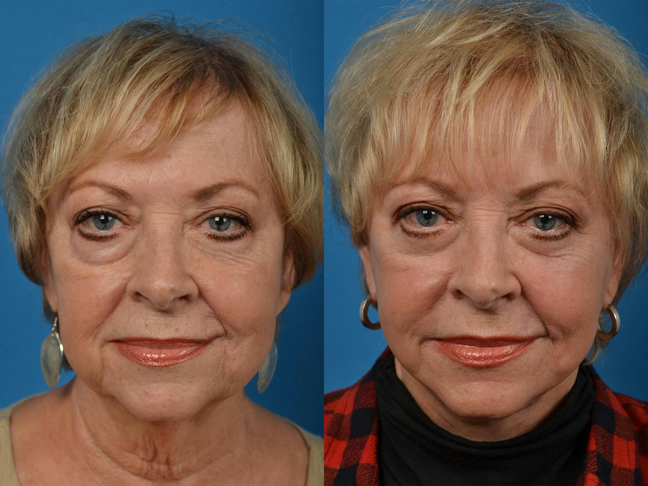 Dermal Fillers Before & After Gallery - Patient 122405775 - Image 1